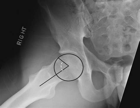 acetabular labral tear test